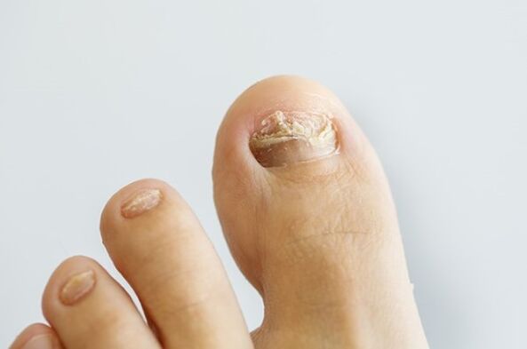 Fungo das uñas