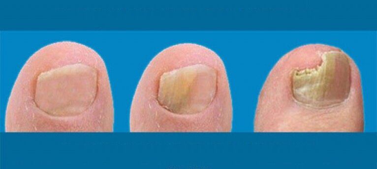 Proceso de desenvolvemento para o fungo das uñas