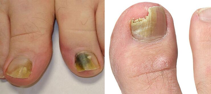 Onicomicosis destrución de uñas cun cogomelo