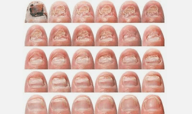 Como é o fungo das uñas