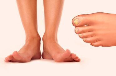 Fungo das uñas