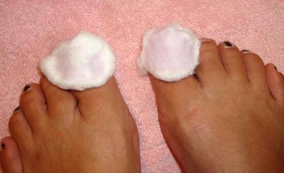 Compresa para tratar fungos nas unhas dos pés