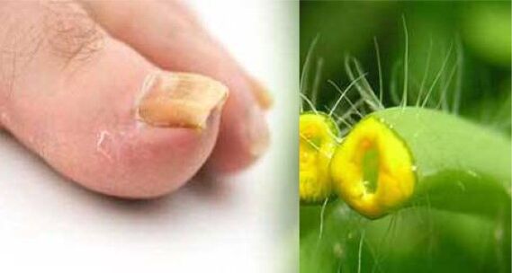 Herba da celidonia contra o fungo das unhas dos pés