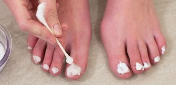 Tratar o fungo das unhas dos pés con pomada
