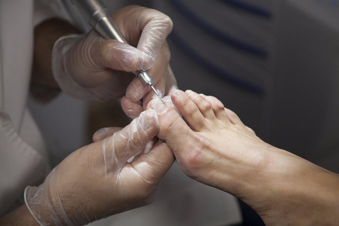 Tratamento profesional de fungos nas unhas dos pés