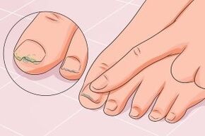 Infección fúngica das unhas