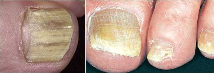 Fungo nas unhas dos pés